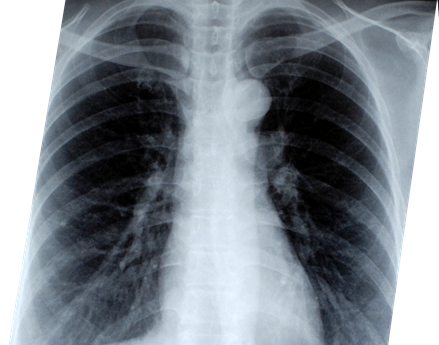 Definicja i Epidemiologia Terminem „rak płuca" określa się raka tchawicy, oskrzeli (dróg oddechowych) i miąższu płucnego